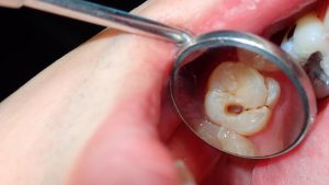 Lee más sobre el artículo Tipos de caries dentales