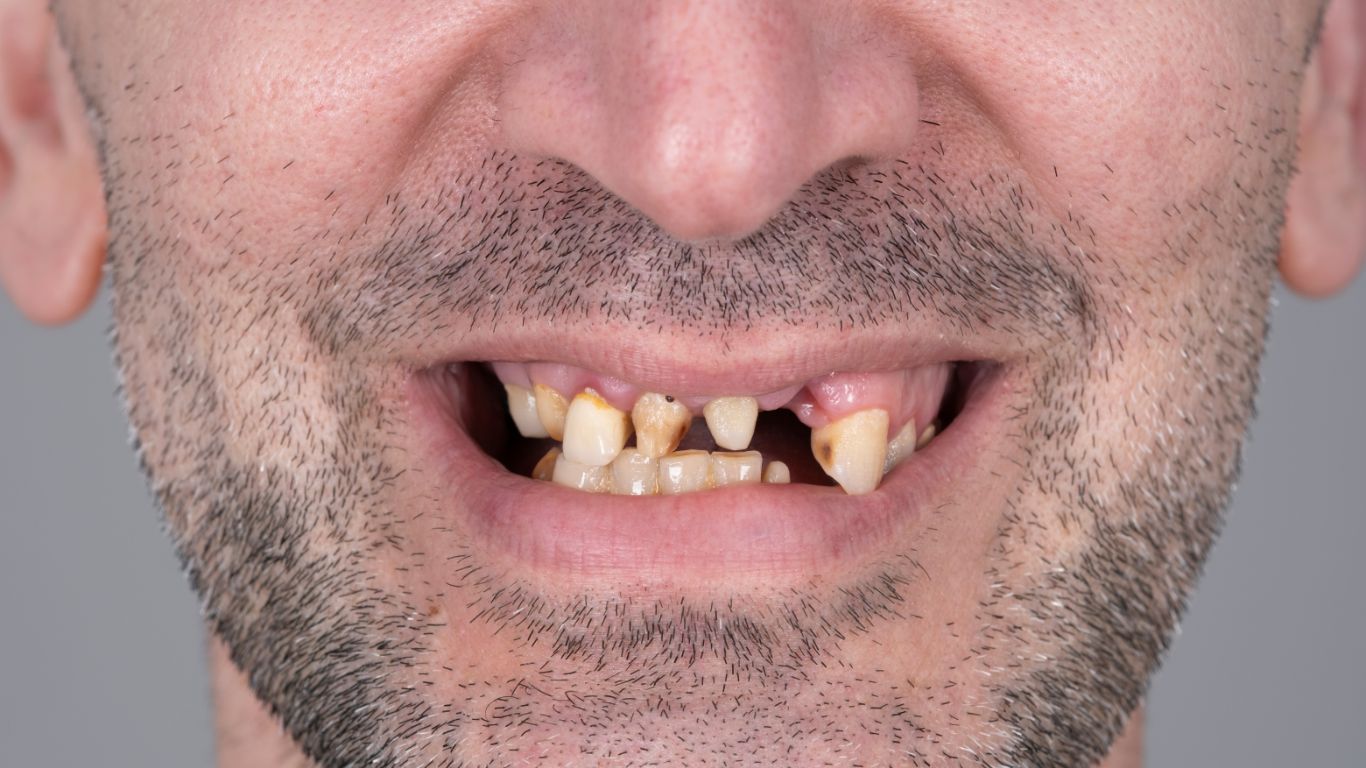 En este momento estás viendo La importancia de reponer las piezas dentales perdidas