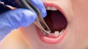 Lee más sobre el artículo Alveolitis Dental: Prevención y Tratamiento